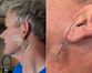 Gordon Ramsay reveals skin cancer scare after undergoing treatment to remove Basal Cell Carcinoma