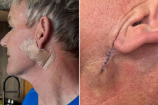 Gordon Ramsay reveals skin cancer scare after undergoing treatment to remove basal cell carcinoma