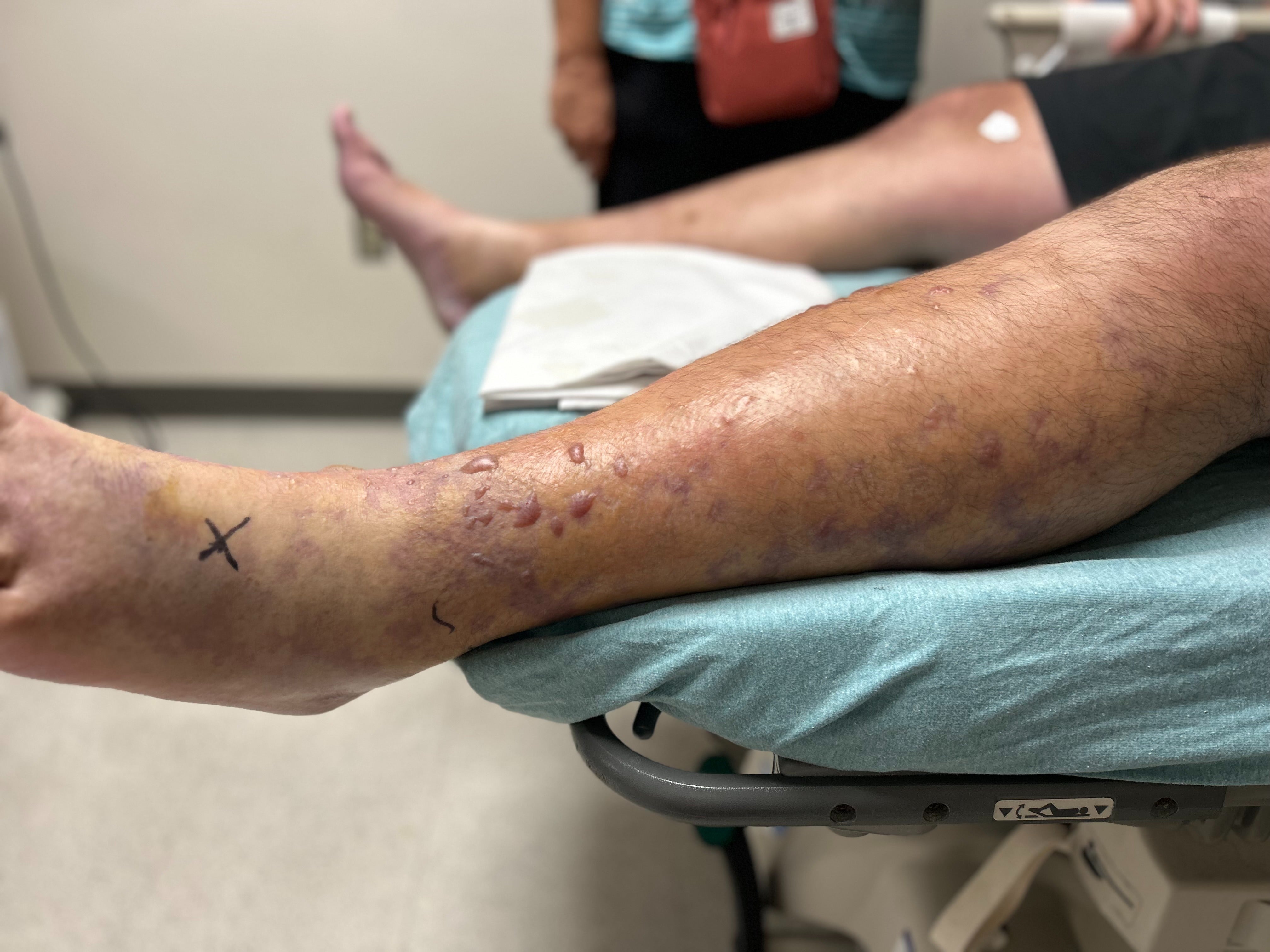 Florida father infected by bacteria that caused severe blisters on leg