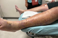 Florida father infected by bacteria that caused severe blisters on leg