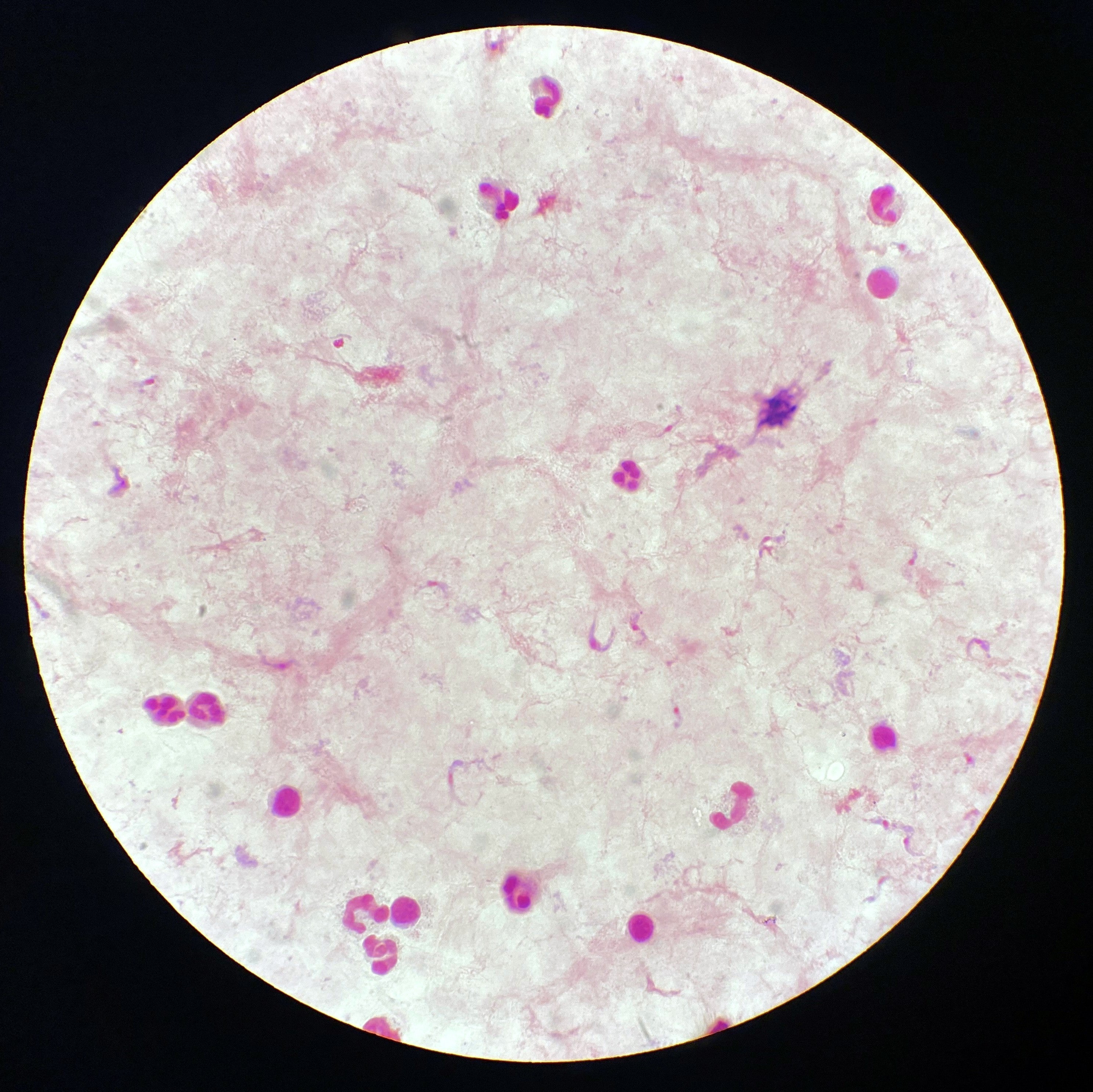 Around 75 million people are at risk of infection worldwide