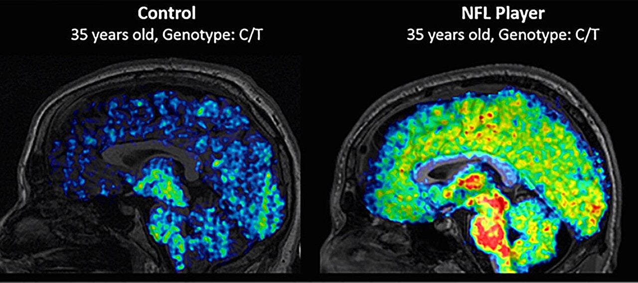 TSPO levels have been found to be higher in active and recently retired NFL players ranging in age from 23 to 39