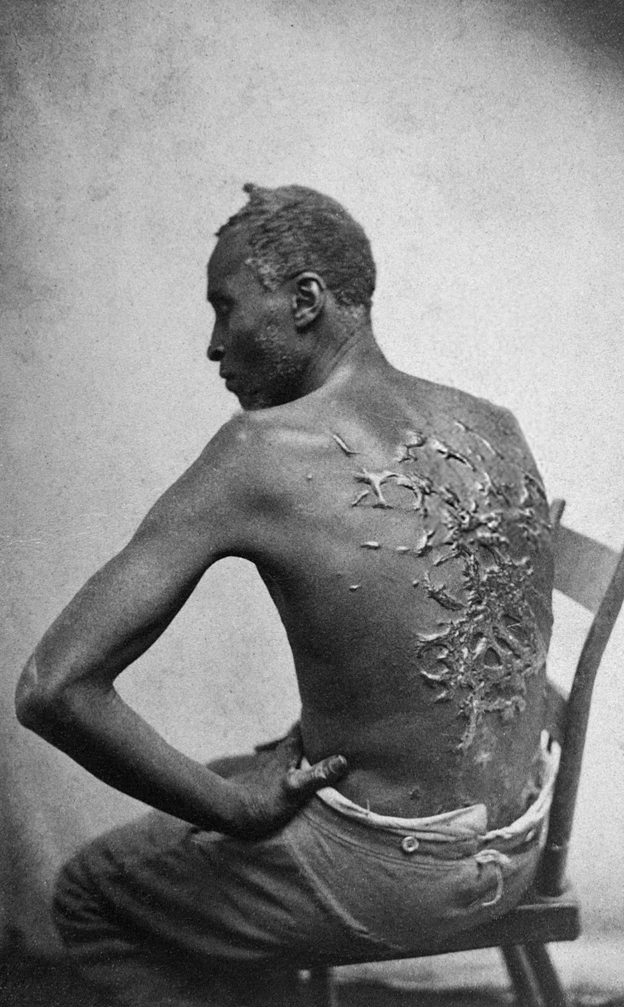 'The Scourged Back', an 1863 photo of a formerly enslaved man named 'Peter', which solidified public support for the abolition of slavery
