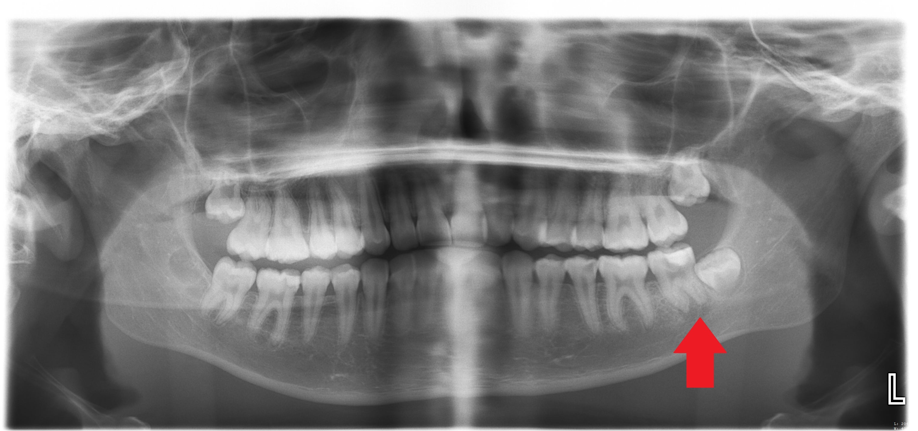 The abscess under Katelyn's decayed lower left second molar