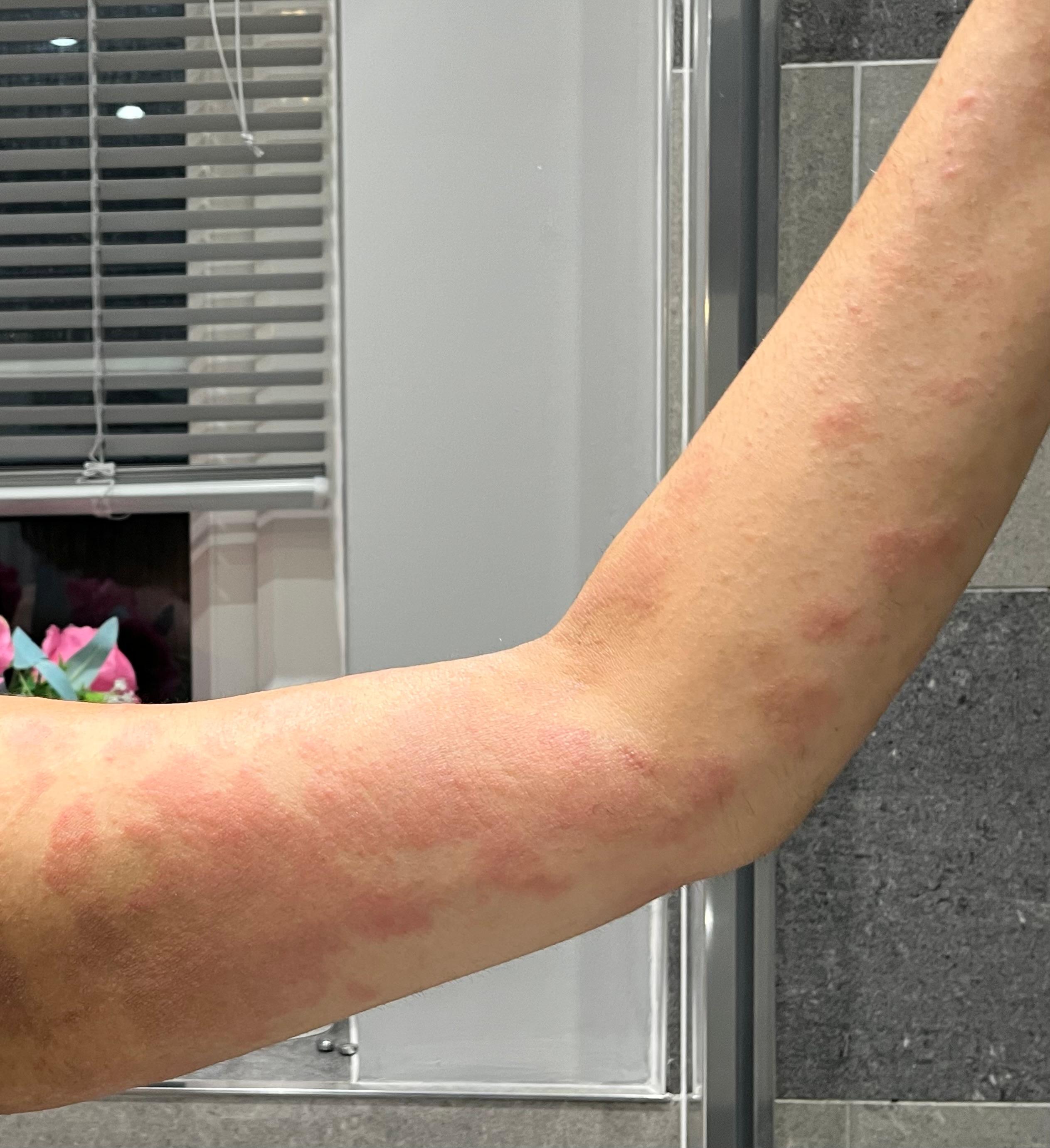 The device measures material changes in each layer of skin using small vibrations on the surface to detect changes in tissue stiffness and fluid