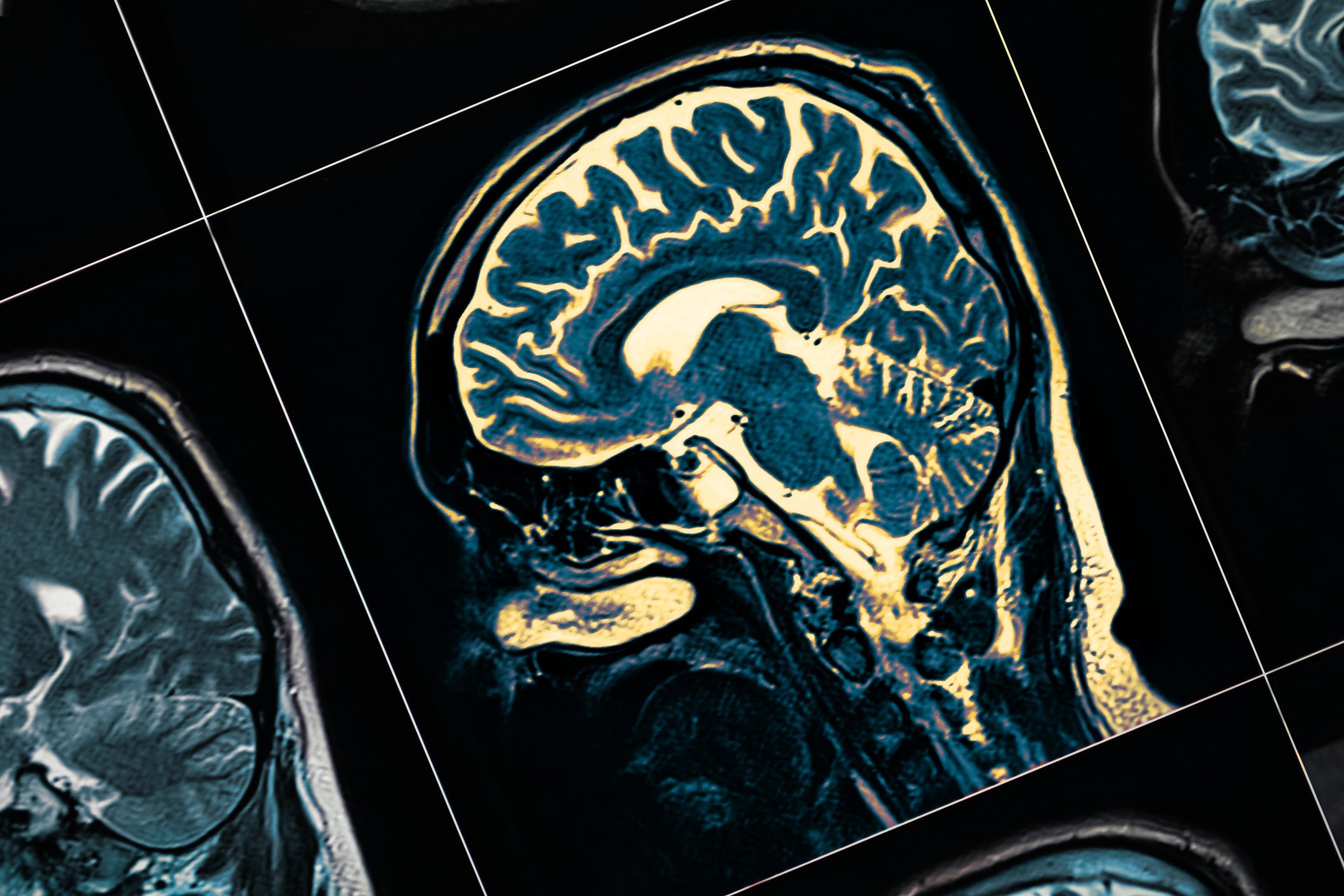 Researchers examined post-mortem brain tissue samples from people with Parkinson’s and compared them to healthy individuals of similar age.