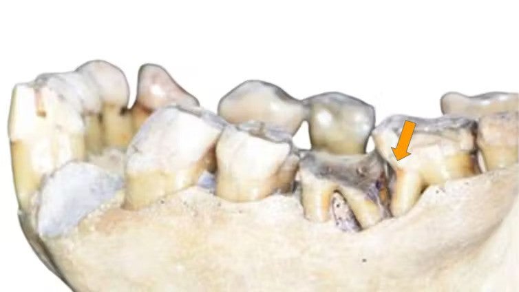 Orangutan (Pongo pygmaeus) with a ‘toothpick groove’ on the lower left second molar