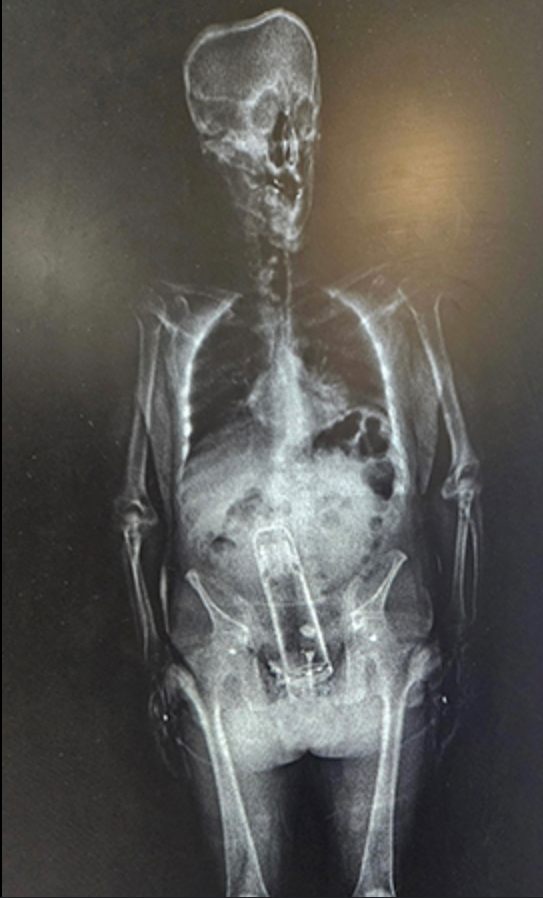 A garrafa térmica encontrada dentro do Frimier precisa de um ‘especialista’ para removê-la
