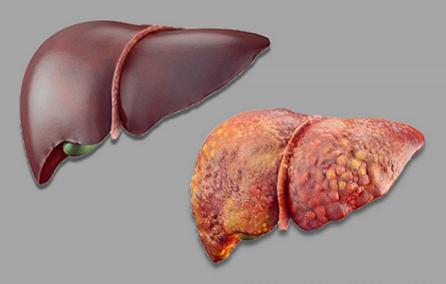 Normal (left) and severely diseased liver (right)