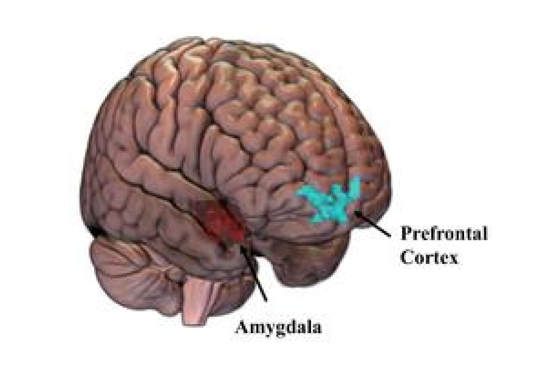 Brain regions altered by PTSD in sexual assault survivors