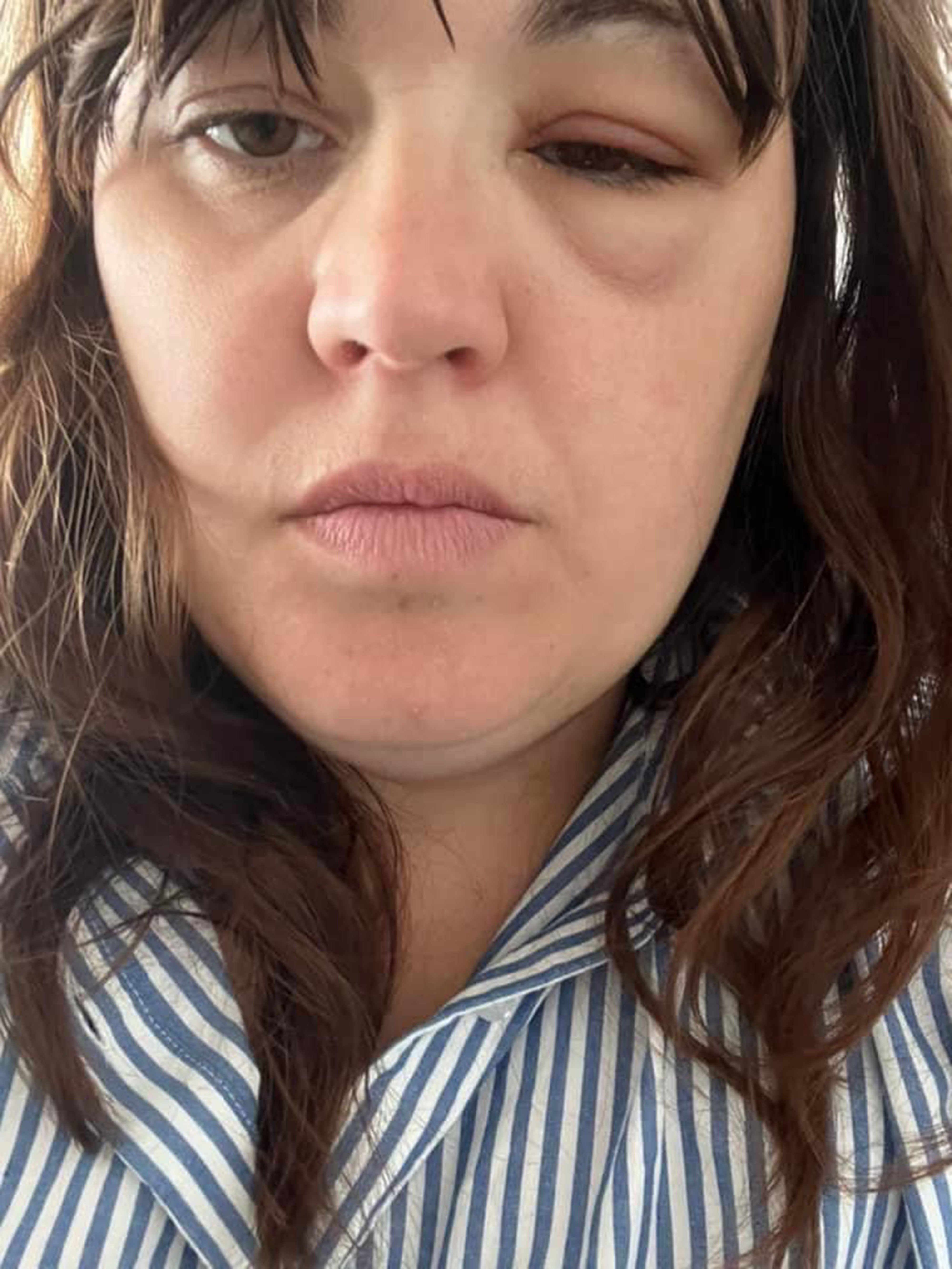 Taylor Pepper’s condition was diagnosed after a routine eye test which detected swelling behind her right eye