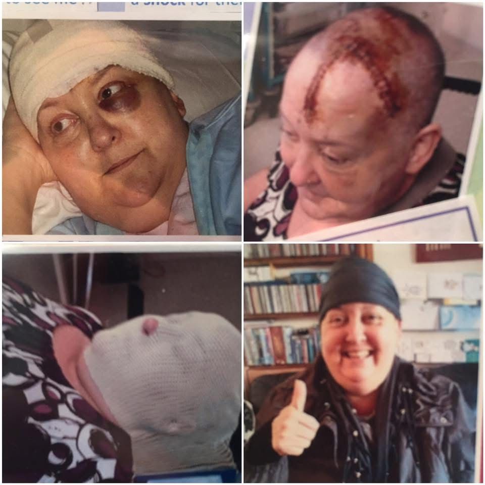 Surgeons removed the centre of the tumour from Gayle's brain in 2011