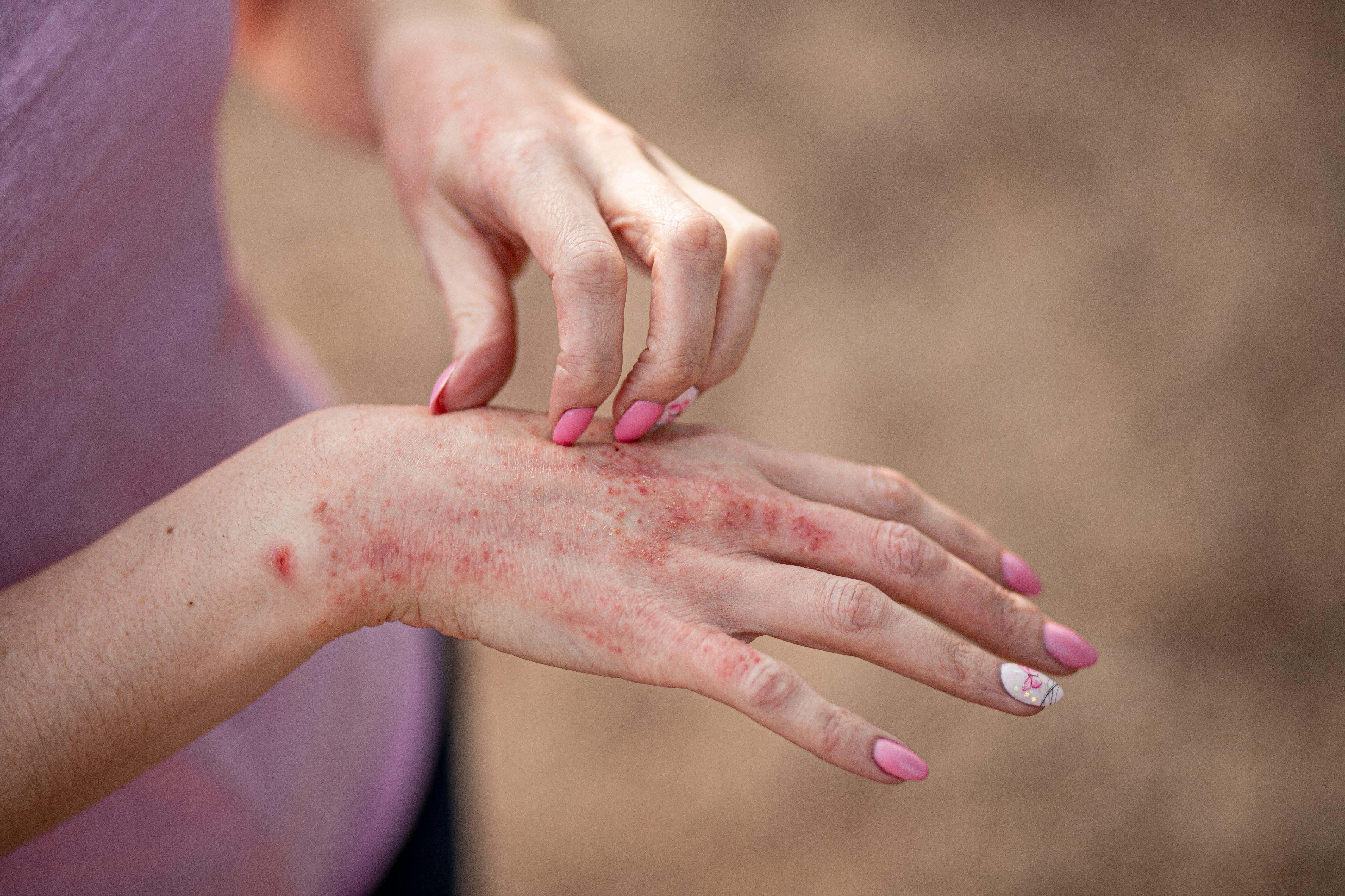 Hand eczema causes the hands to become dry, sore, cracked and itchy (Alamy/PA)