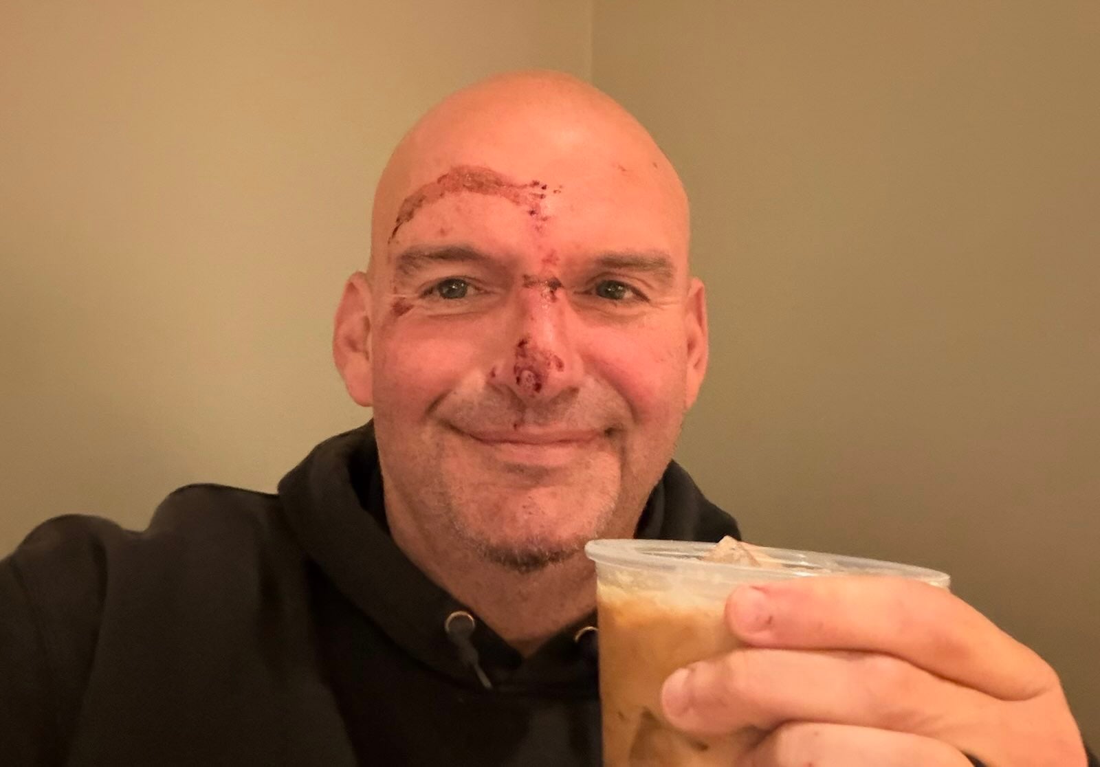 Pennsylvania Sen. John Fetterman revealed that he received 20 stitches following a fall near his home two days ago, prompted by a flare-up of a cardiac-related issue
