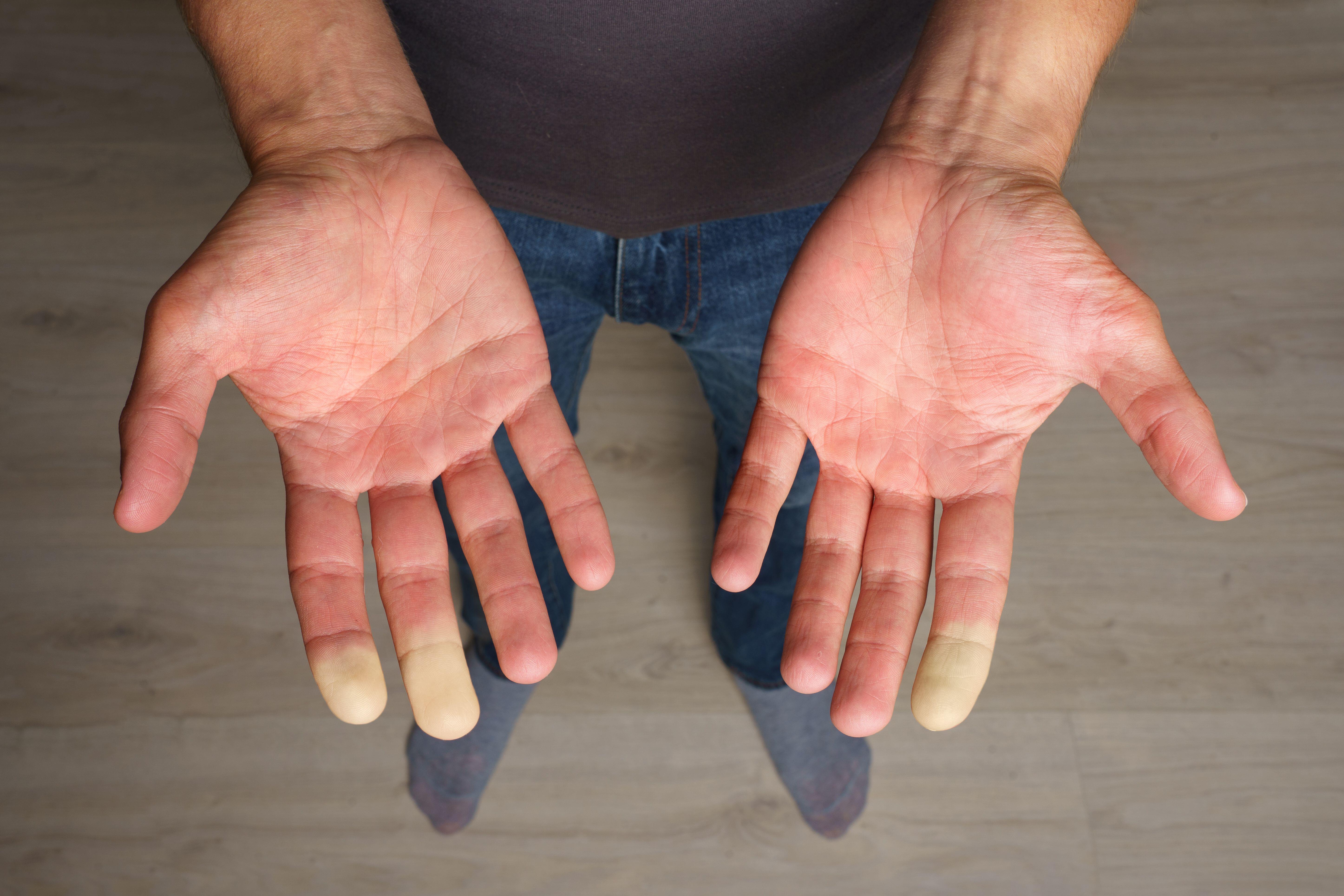 Man with Raynaud’s showing his hands