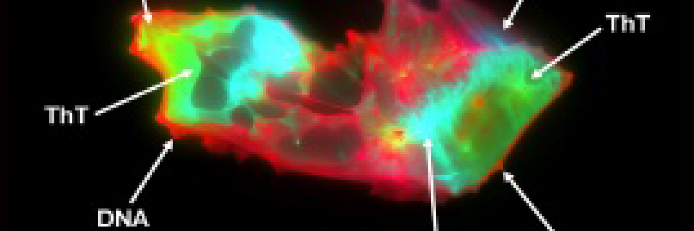 Microscope image of a microclot found in the blood of a person with Long Covid