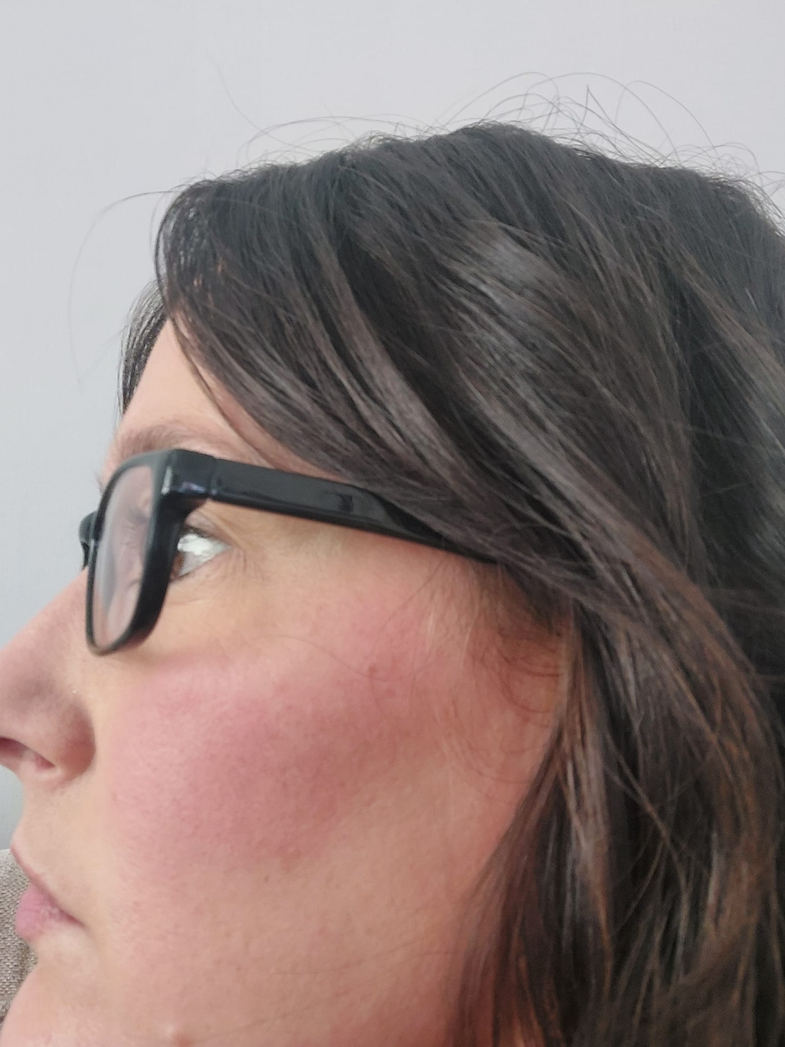 Ms Pearson uffers with red, itchy and swollen skin after exposure to the cold