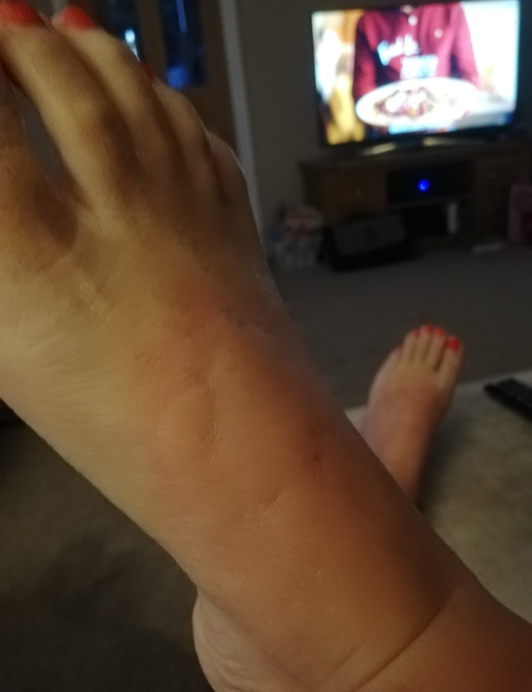 Her skin breaks out in hives resembling nettle stings