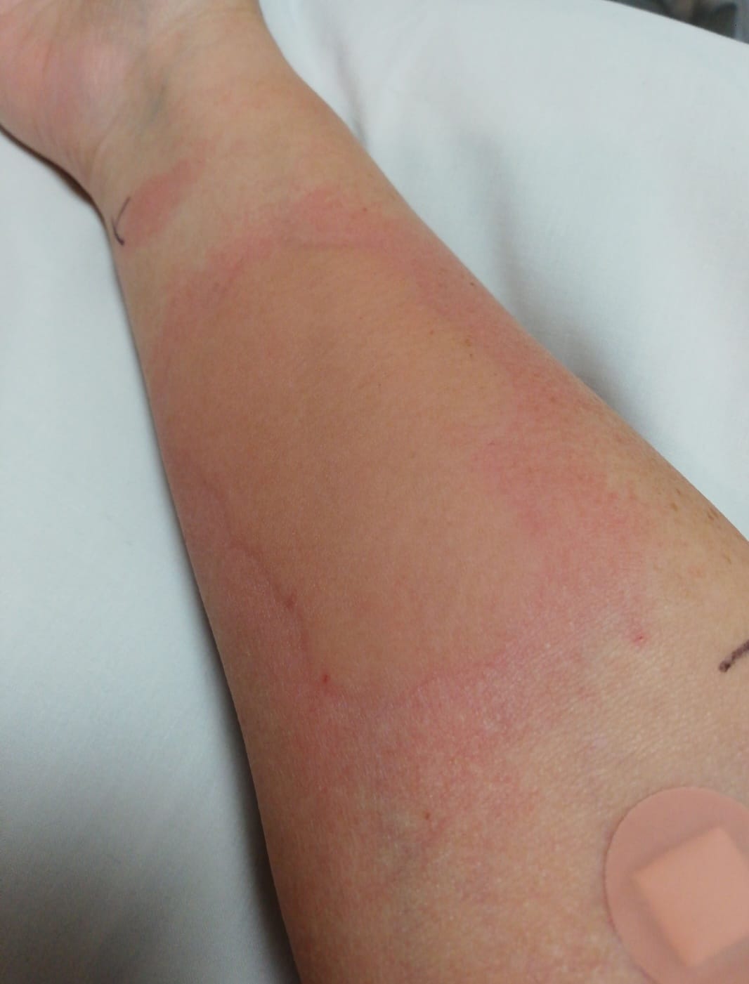 She said her skin ‘came up with a massive welt’ during the ice cube test