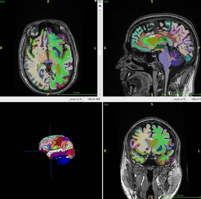 The doctors took MRI scans, feeding it into an AI algorithm to help determine patients’ brain ages