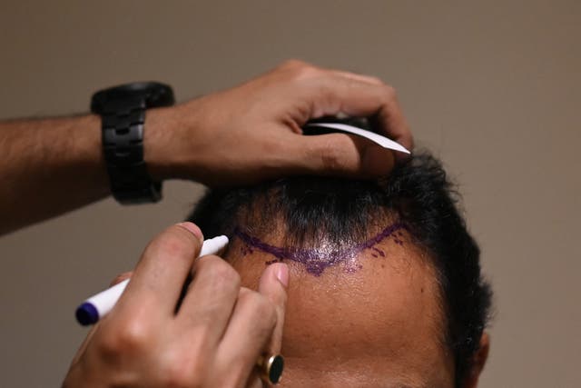 <p>Dr Mayank Singh makes hairline markings on the scalp of a hair transplant patient </p>