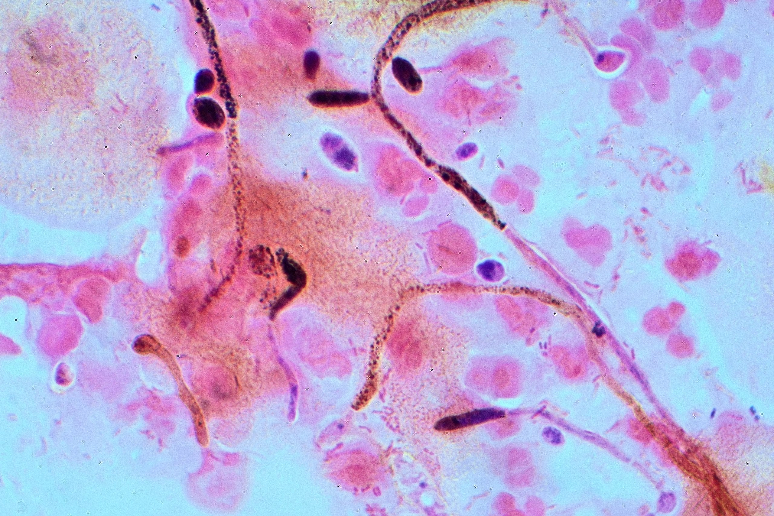A gram stain of Candida albicans (thrush) from a vaginal swab