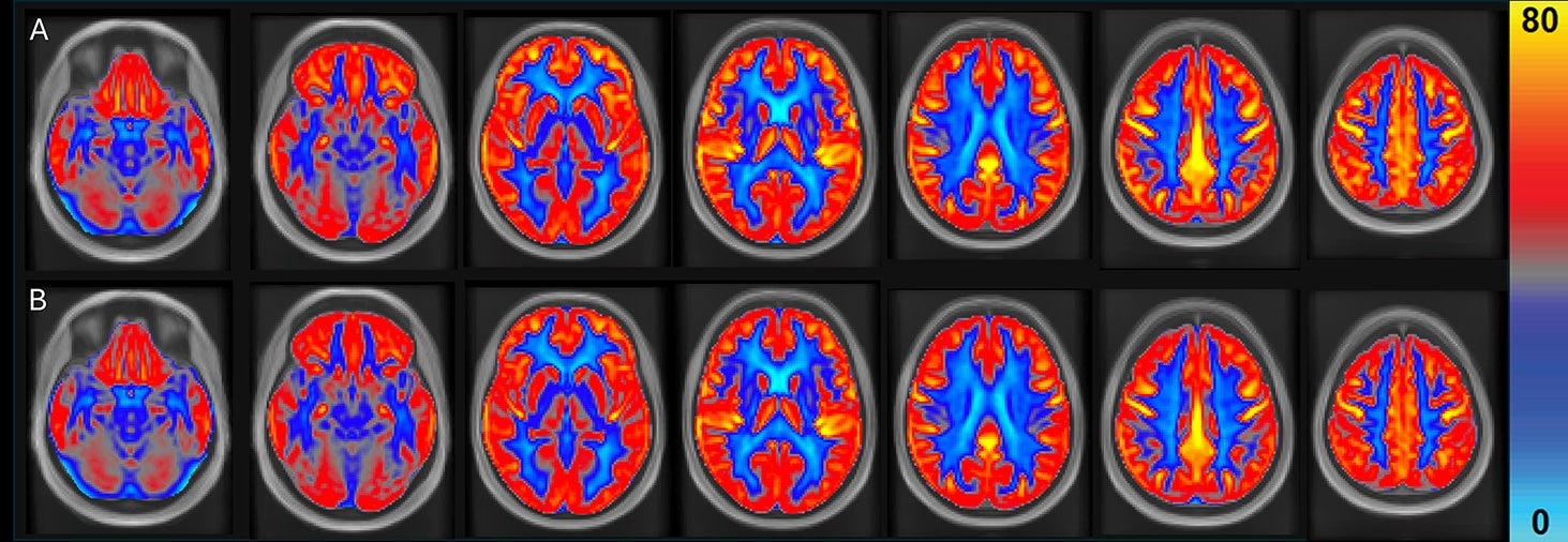 Average cerebral blood flow is shown to increase, in yellow, after eating peanuts in brain scans listed as A. The scans in B mark control periods