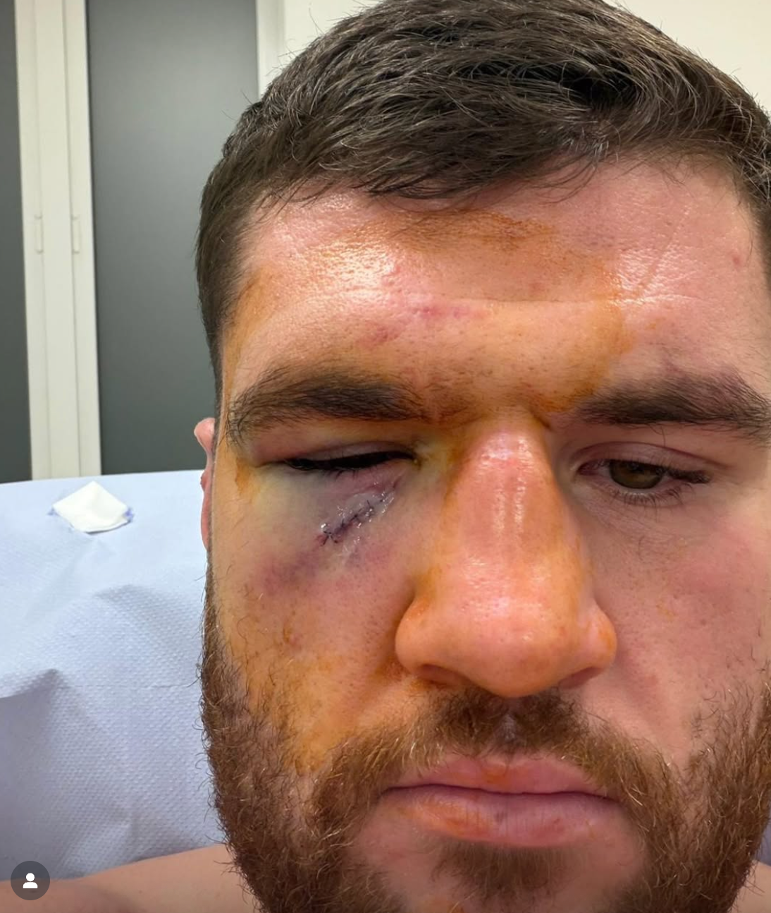 Johnny Fisher’s pre-fight cut and stitches