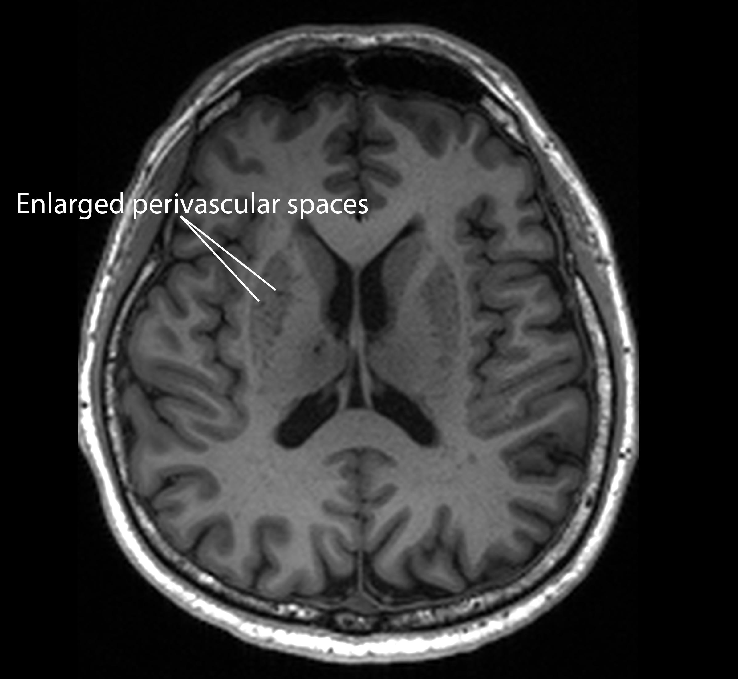 Magnetic resonance imaging image of a patient who has enlarged perivascular spaces, which are seen as dark lesions in dark grey regions around the center of the brain