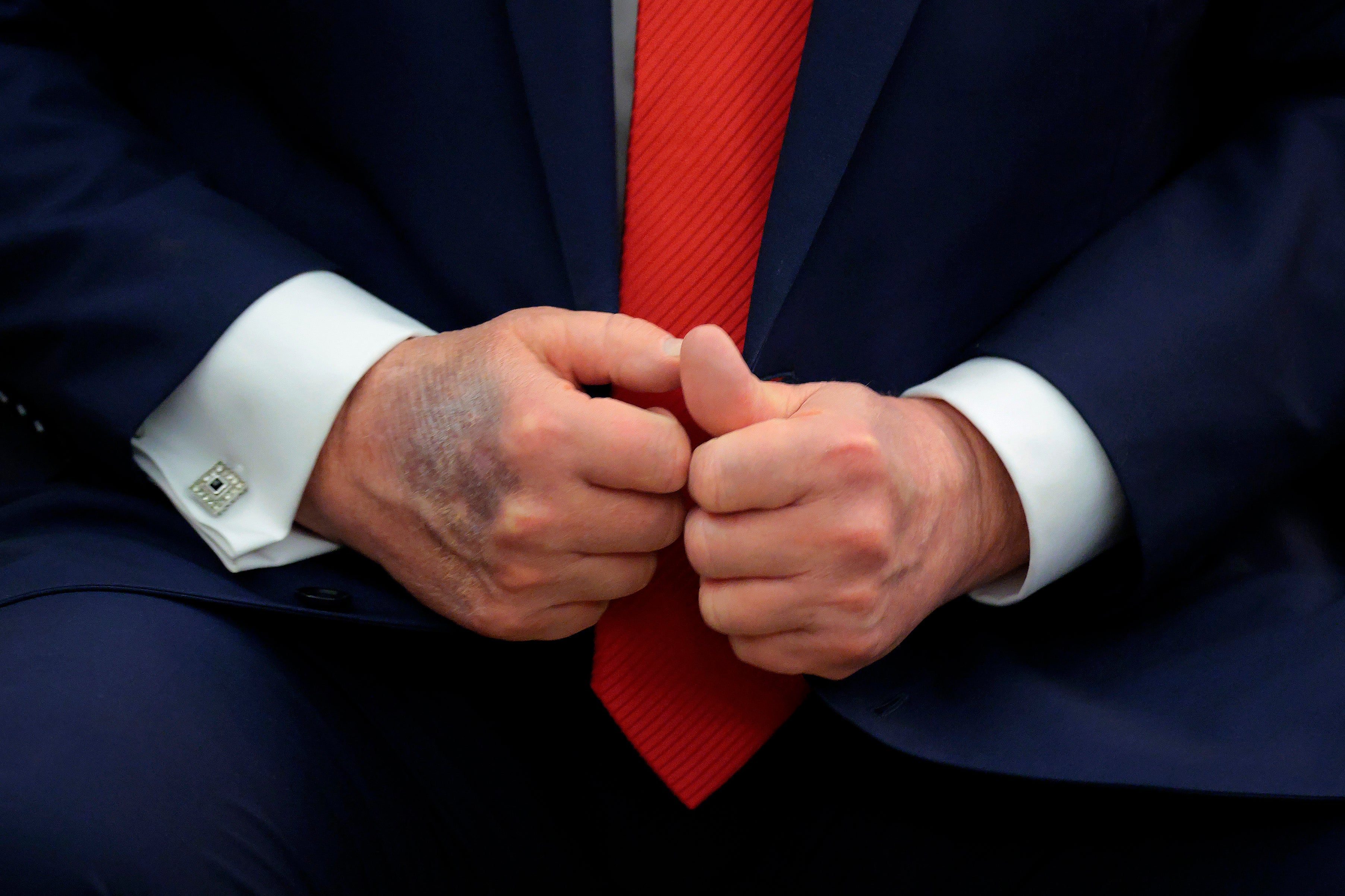 Trump’s bruised hand is often seen slathered with makeup