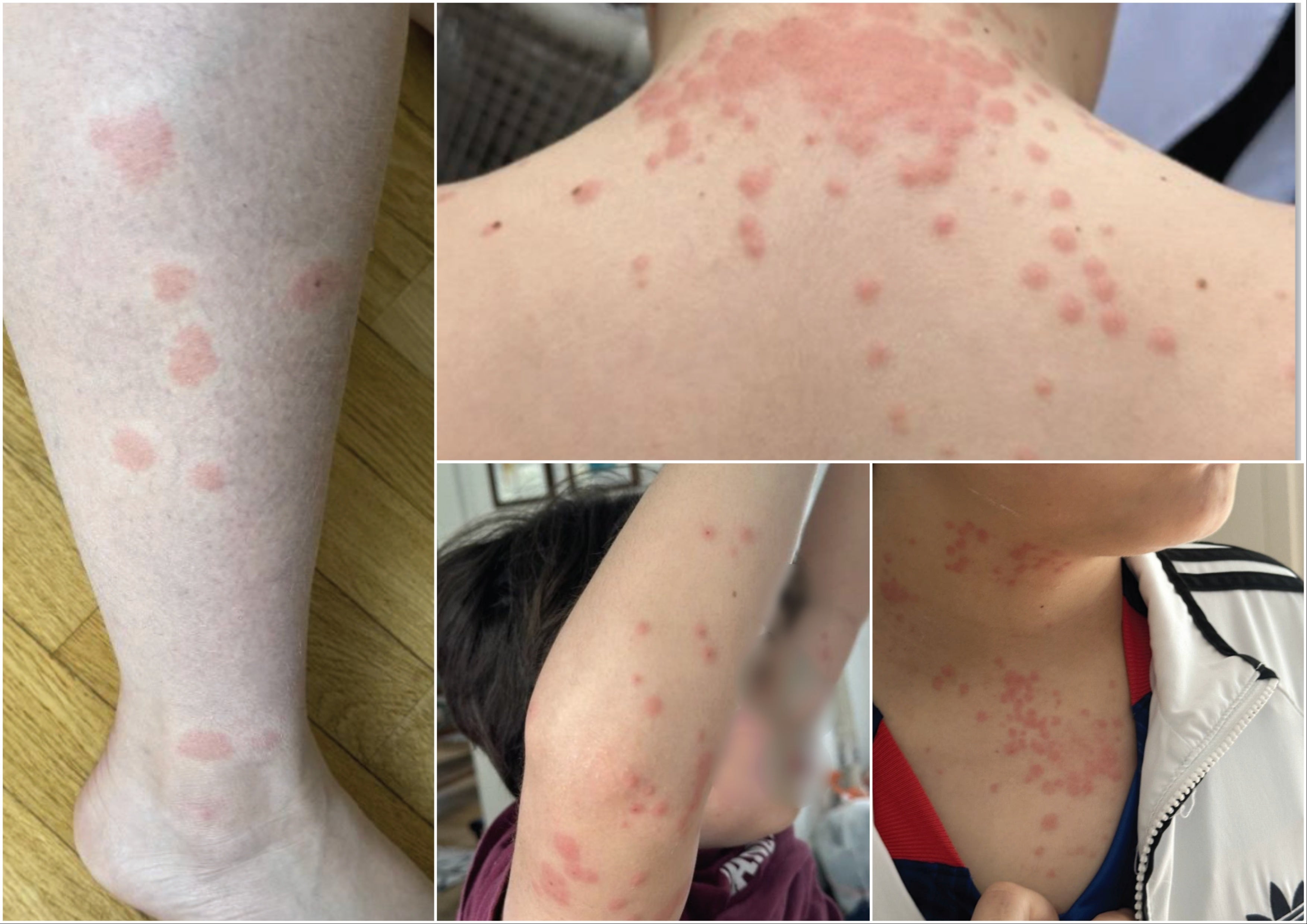 The Albuquerque family says they were bitten all over, and are now seeking $200,000 from Delta and KLM.