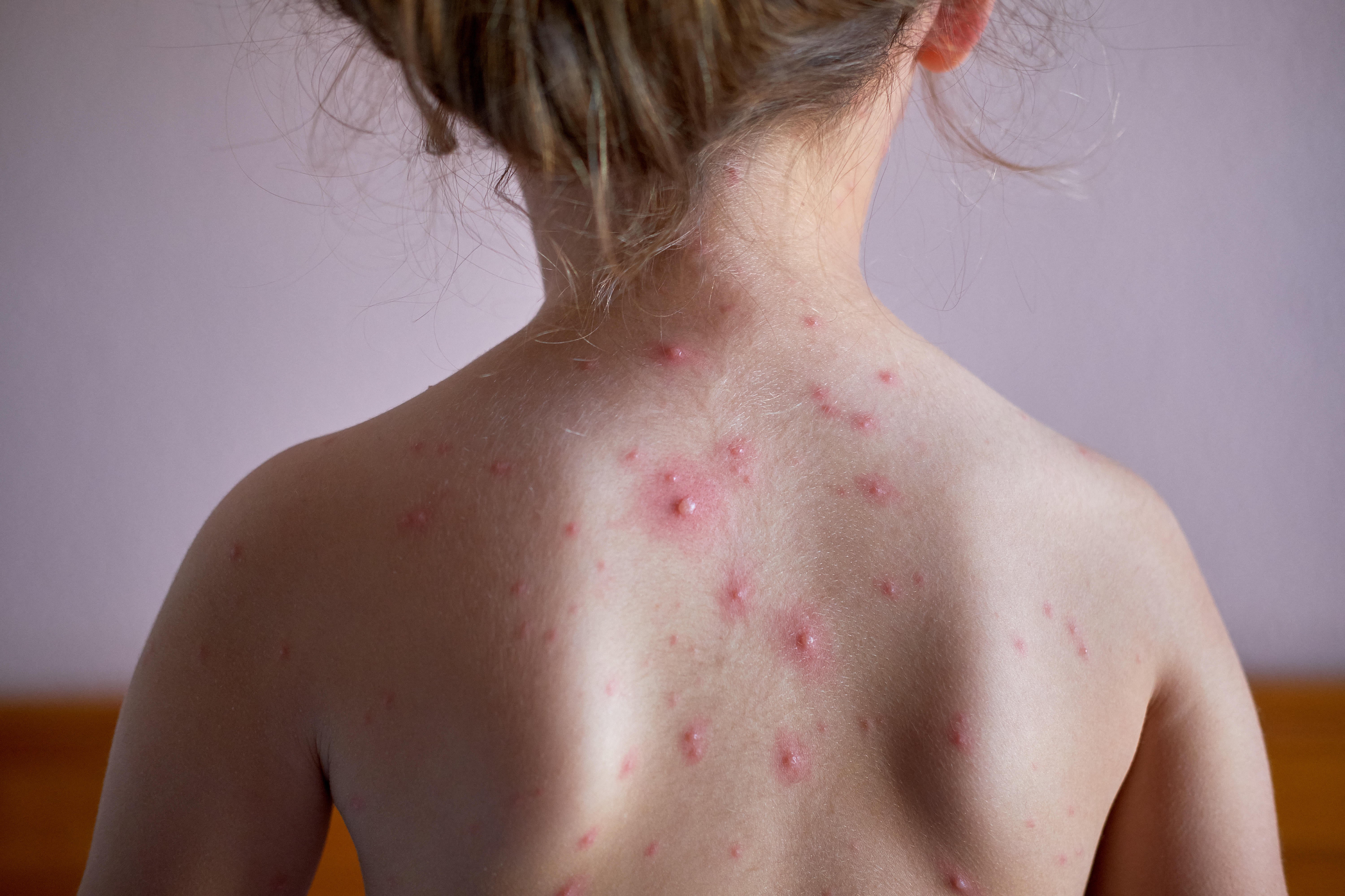 Chickenpox is mostly mild, but serious complications can develop