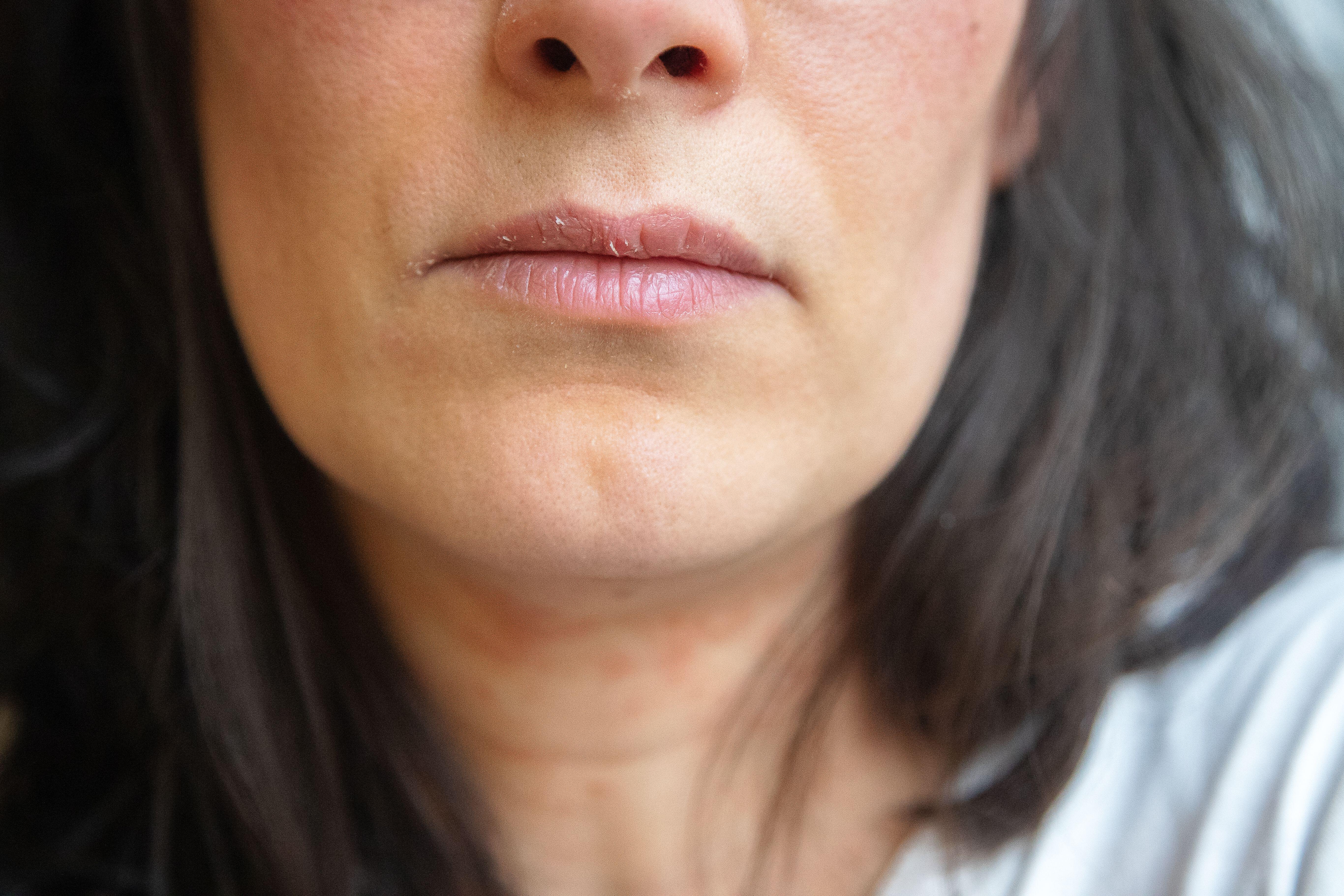 Dry mouth, lips and tongue are a sign of dehydration