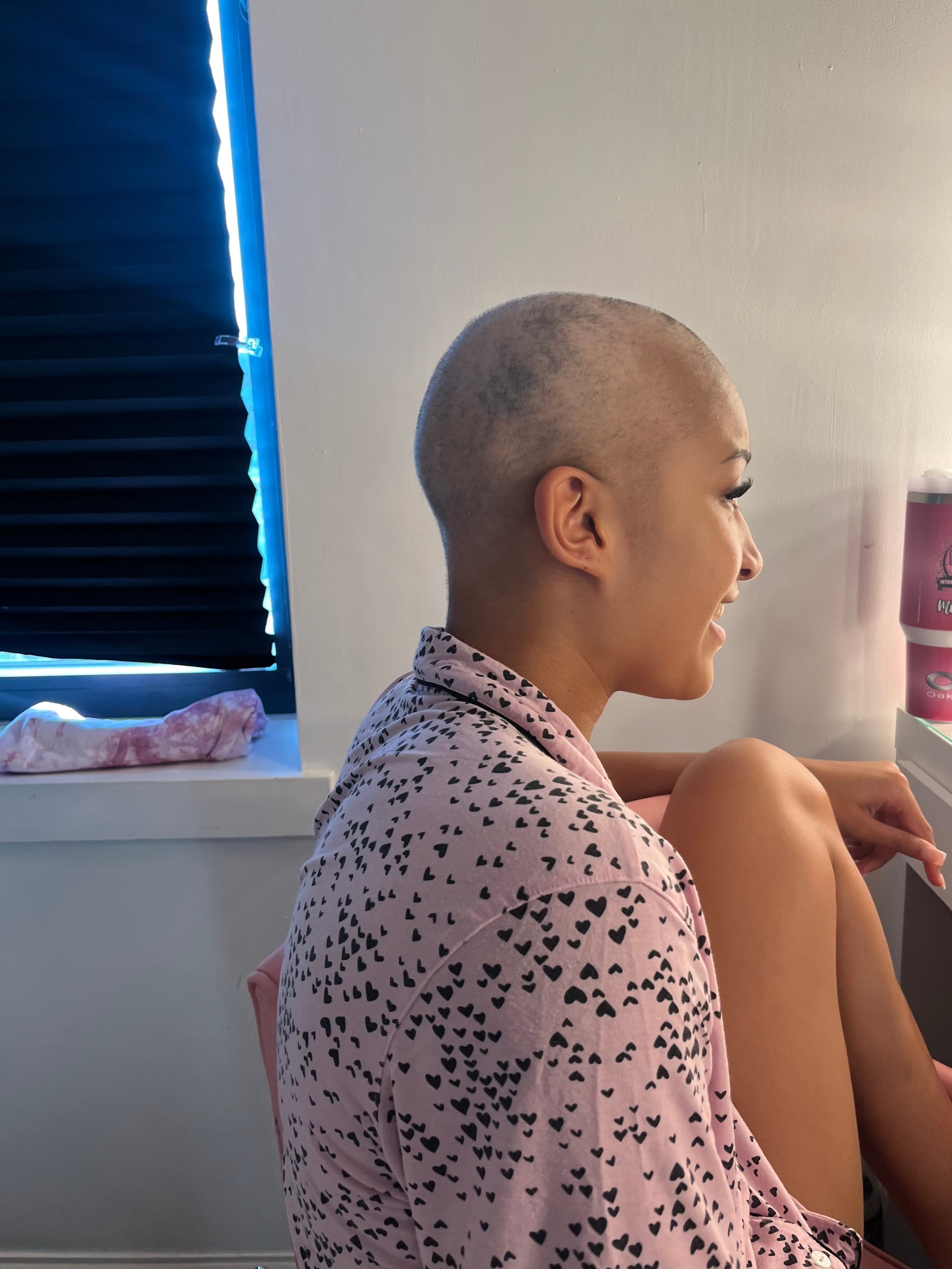 ‘I lost all my hair, basically every single hair on my body’