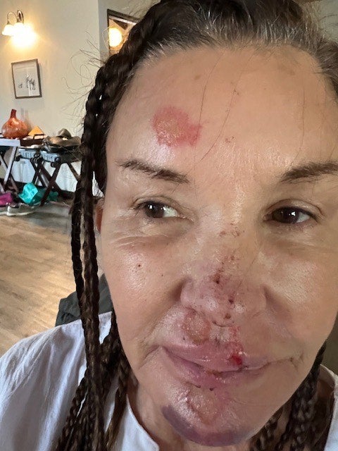 Janice Dickinson’s injuries to her face that she claims she sustained while on the reality TV show 'I'm a Celebrity South Africa'