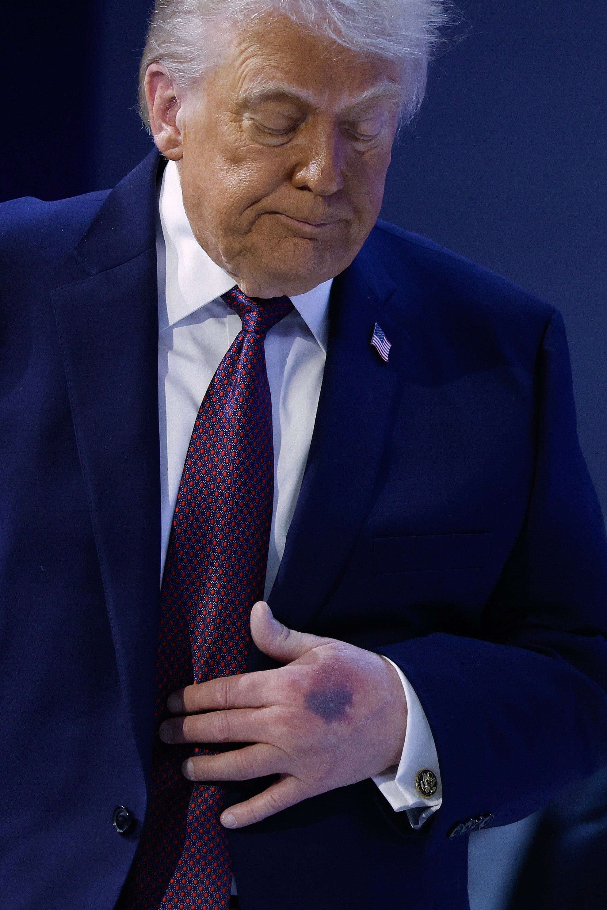 The bruising to Trump’s left hand was prominent in photos taken Thursday at the World Economic Forum