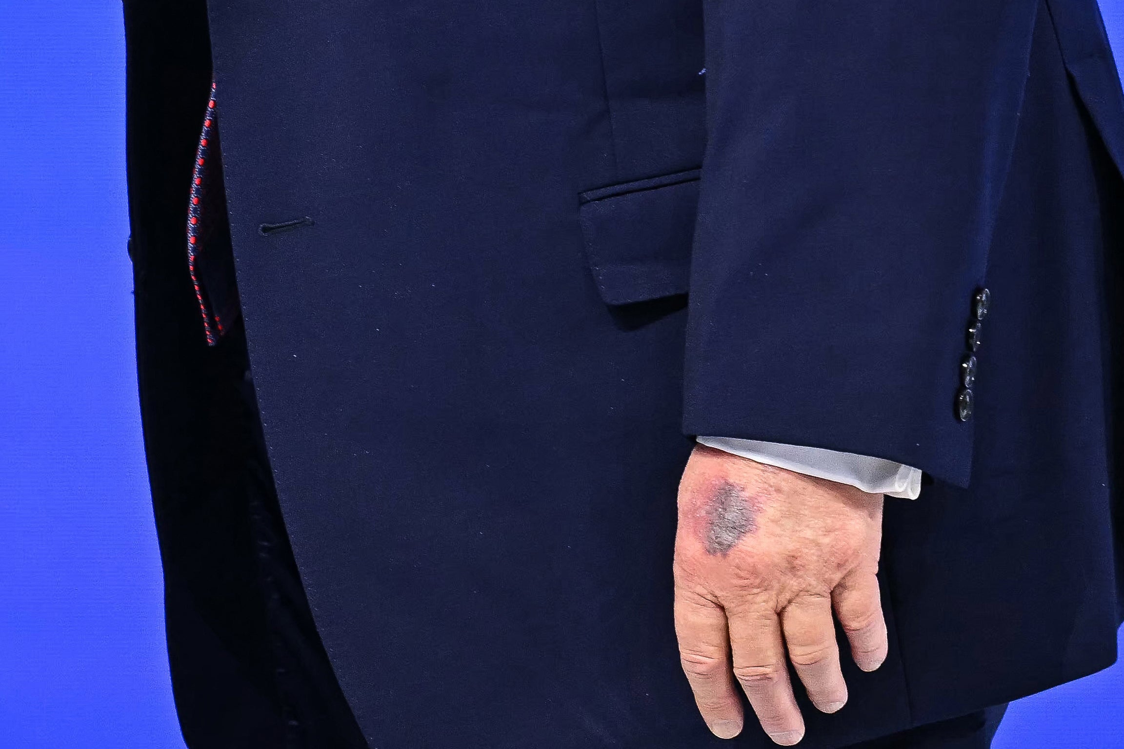 Trump addressed his health in a recent interview with The Wall Street Journal and acknowledged that he applies makeup to his hands for when he gets ‘whacked again by someone’