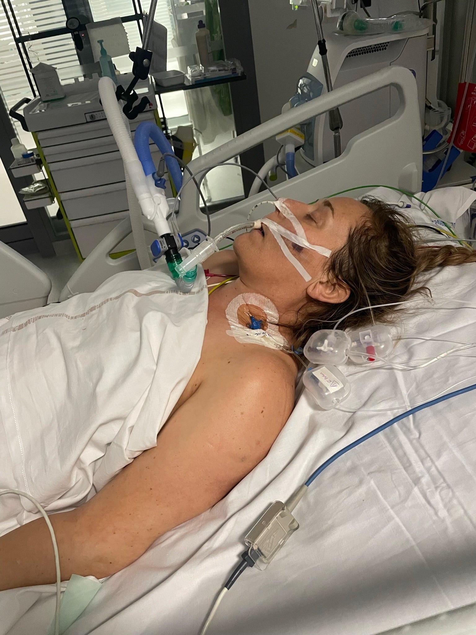 Mum lost leg to flesh-eating disease after thinking she had a cold