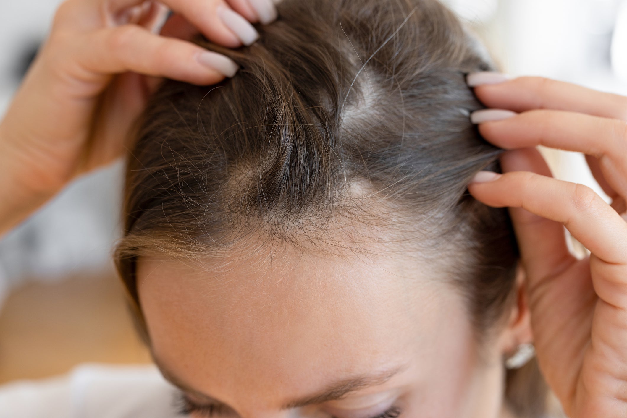 Severe hair loss causes ‘distress’ for women, judges have said in a landmark case