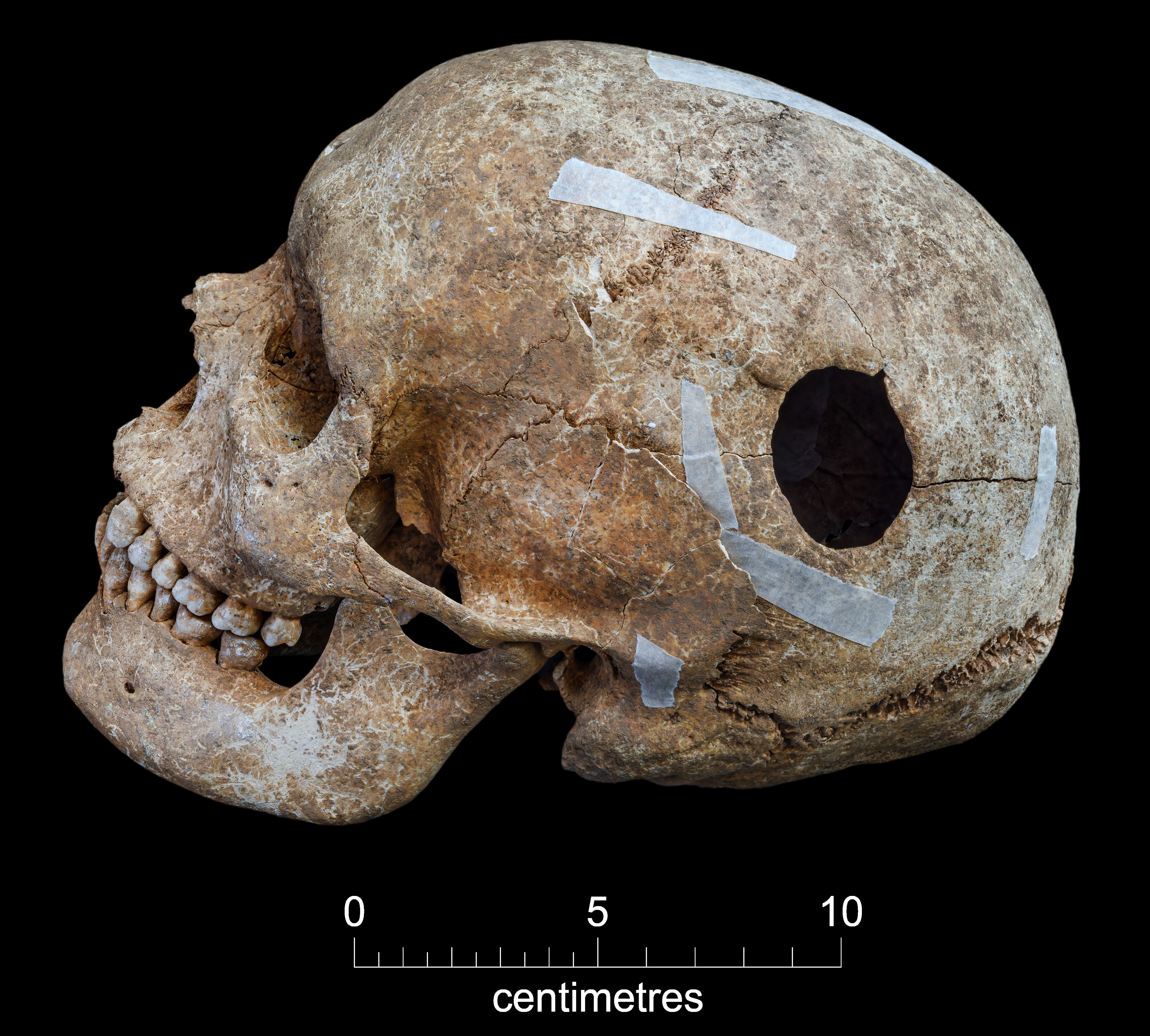 A skull found in the burial pit with a 3cm diameter hole