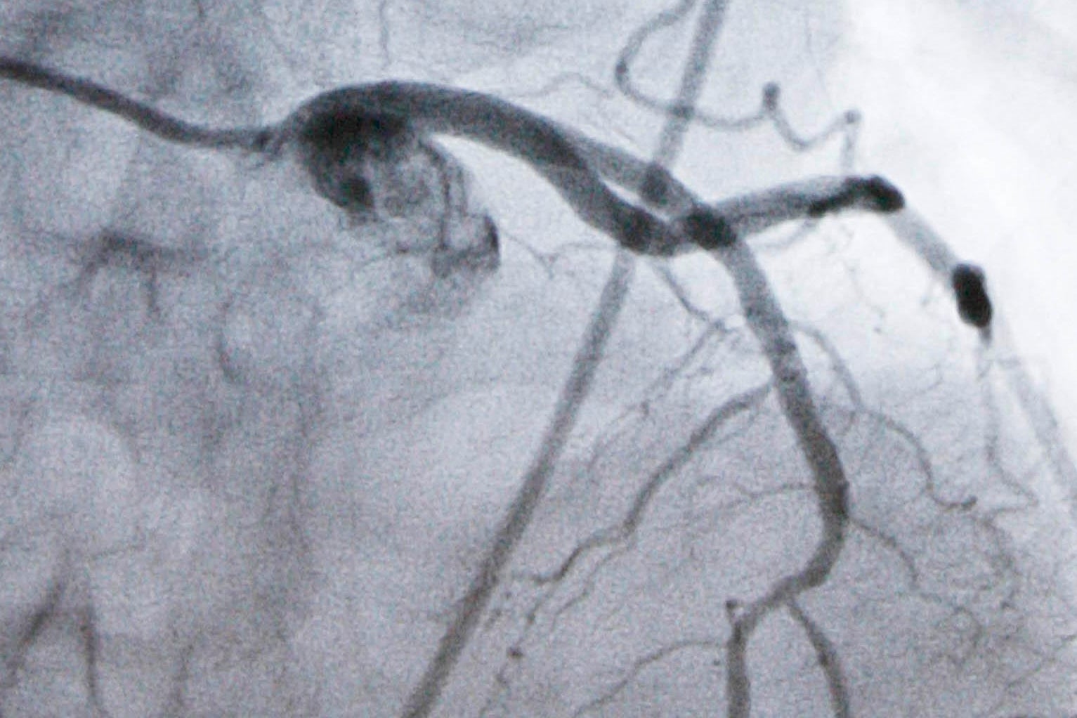A monitor shows an artery during a catheterization lab heart procedure in Burlington, Vt., Tuesday, Sept. 23, 2008. (AP Photo/Toby Talbot, File)