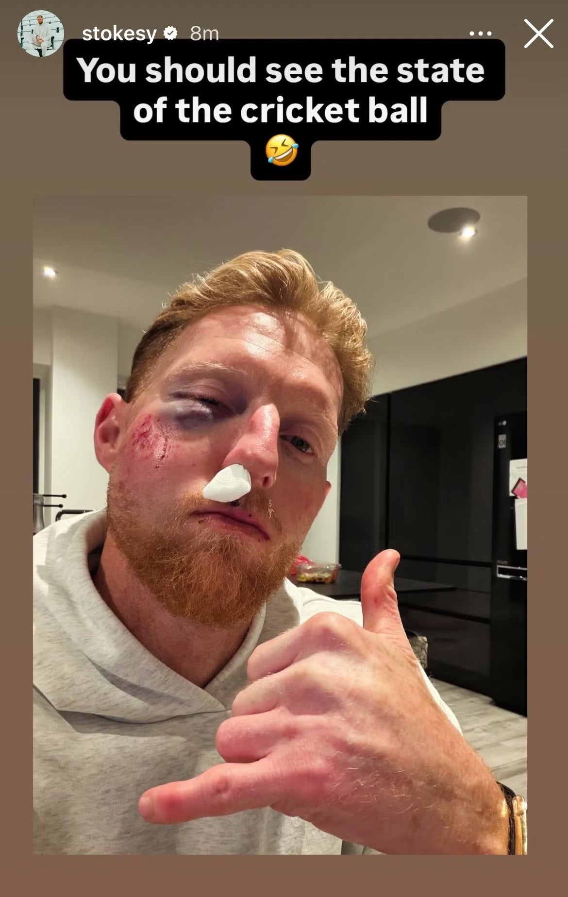 Ben Stokes has suffered a significant facial injury