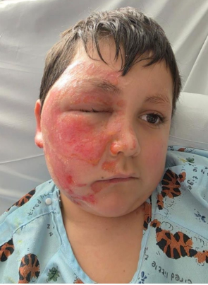 Caleb suffered second-degree burns after the microwaved toy exploded on his face