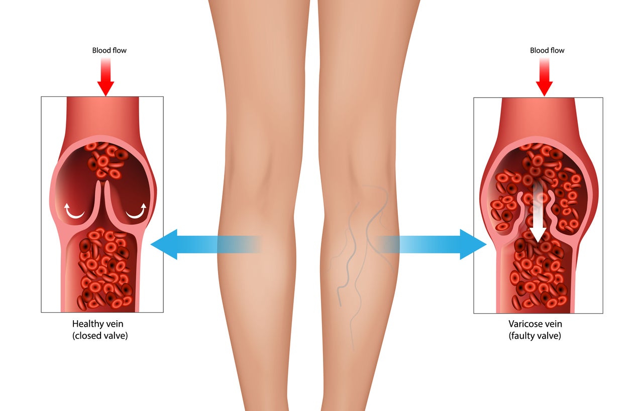 A graphic image shows a healthy vein in a woman’s left leg and a faulty vein in her right leg. In varicose veins, which are commonly seen in venous insufficiency, damaged valves back up blood, resulting in swollen veins and causing bruises