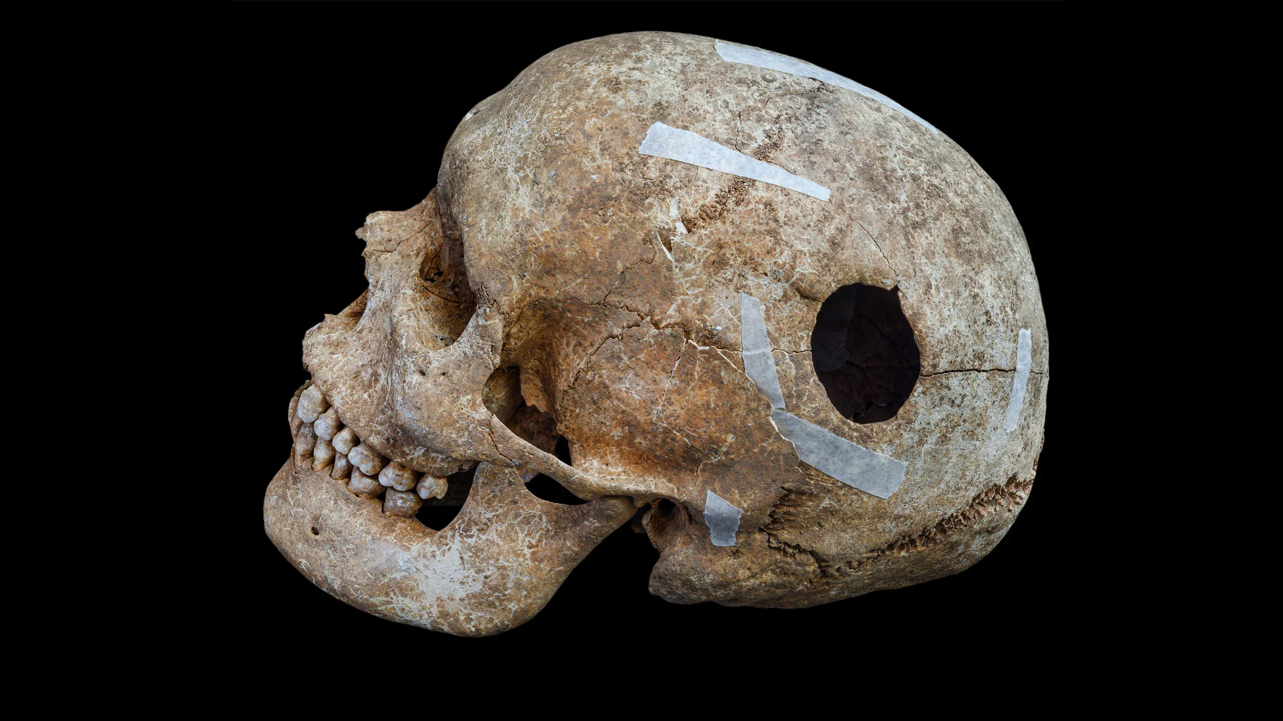 Skull with evidence of trepanning