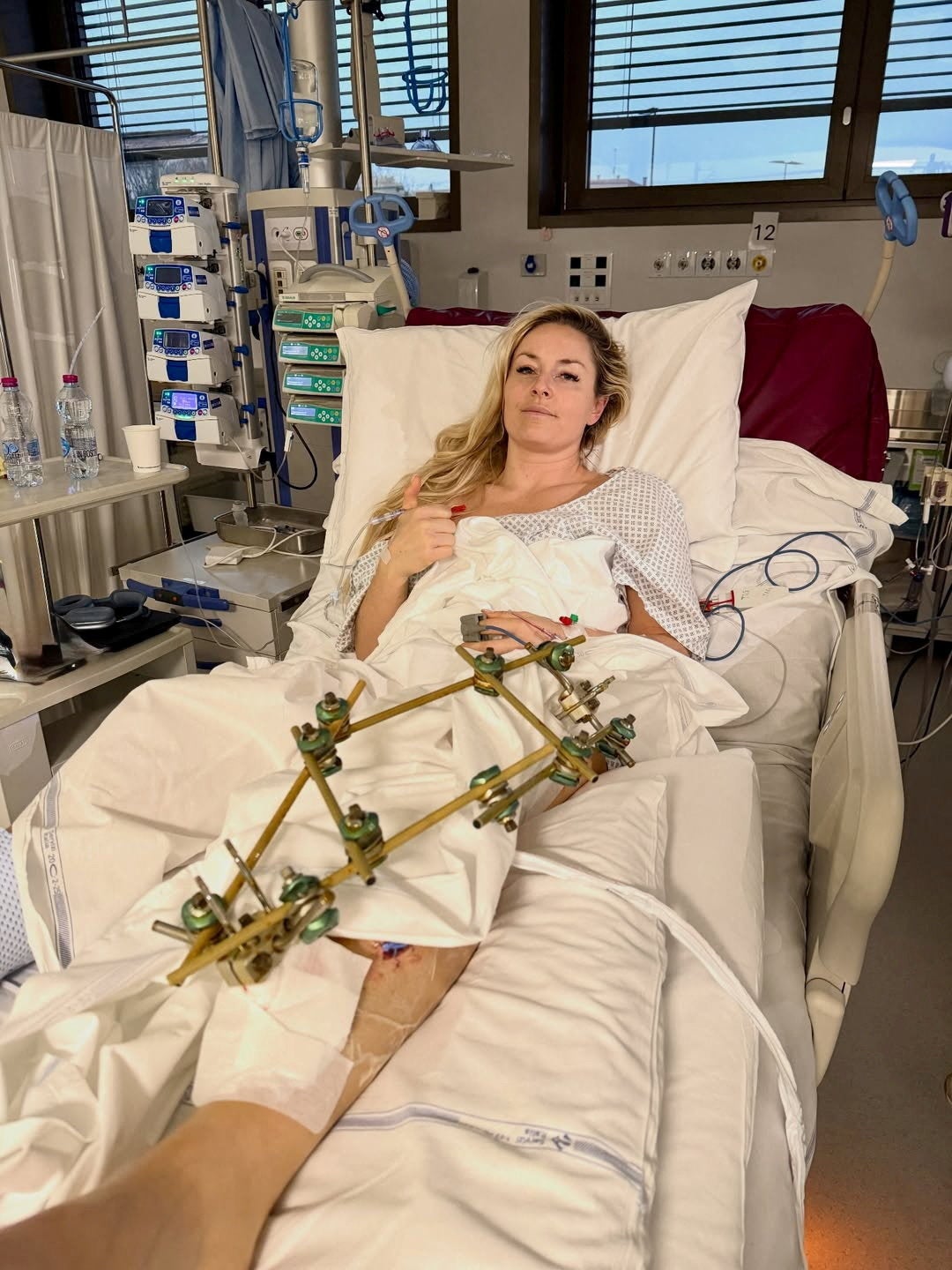 Lindsey Vonn had a third surgery on her broken leg