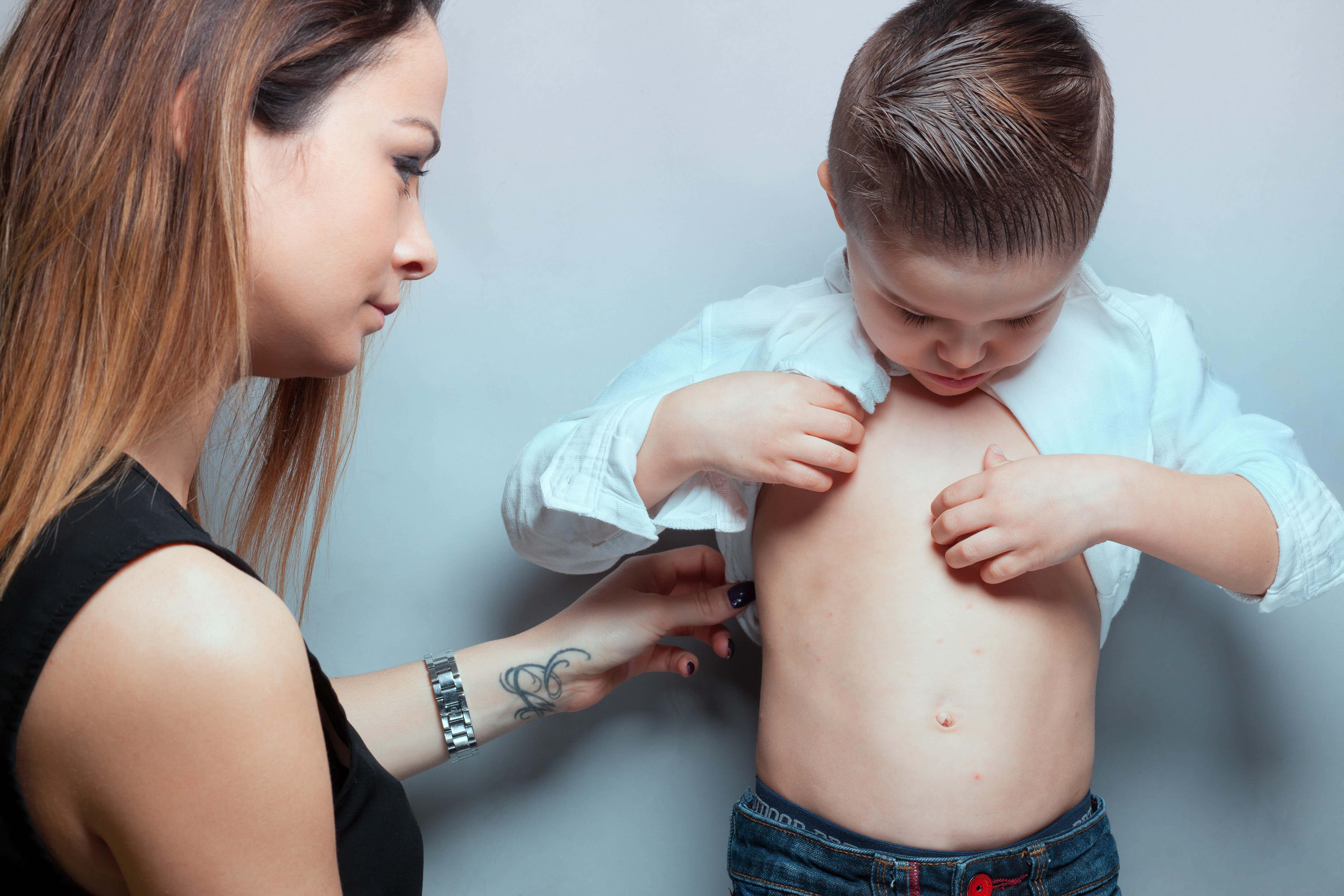Measles is very contagious, so it’s very important to seek medical attention (Alamy/PA)