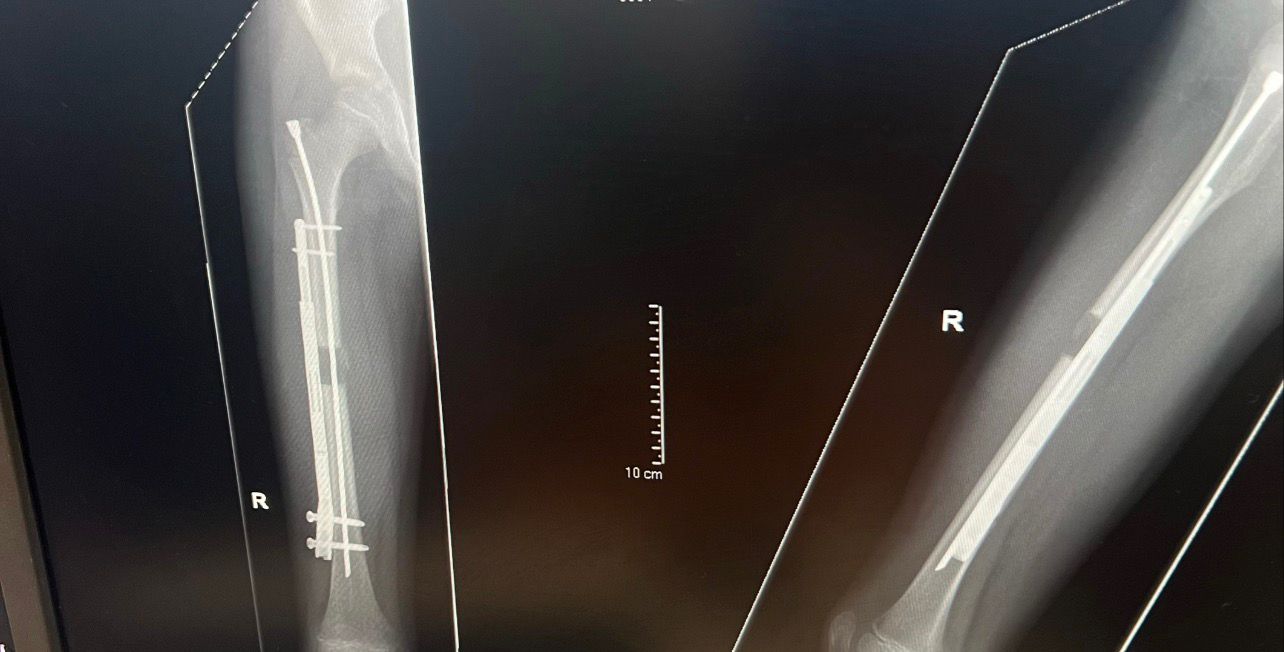 X rays of Alfie’s leg showing the nail alongside his bone (Laura Ducker/PA)