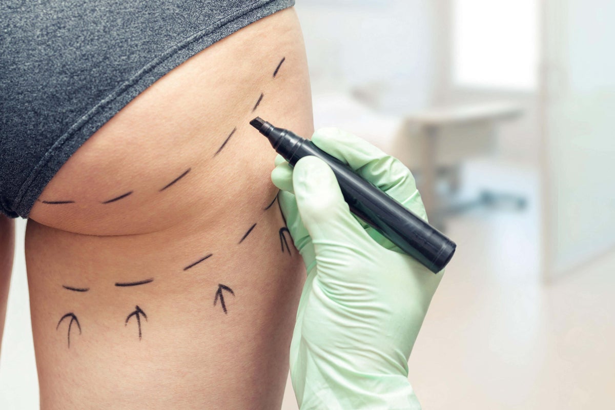 Delaying Brazilian Butt Lift ban poses ‘serious threat to patient safety' MPs warn