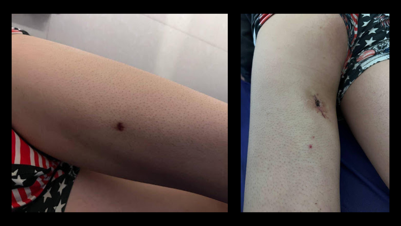 A bullet has entered through the front of the thigh and exited through the back, known as a through-and-through wound